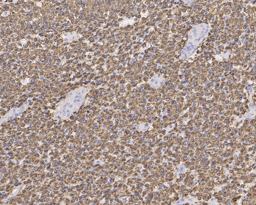 Immunohistochemical analysis of paraffin-embedded human brain tissue with Rabbit anti-GFAP antibody (ET1601-23) at 1/50 dilution.<br />
<br />
The section was pre-treated using heat mediated antigen retrieval with Tris-EDTA buffer (pH 9.0) for 20 minutes. The tissues were blocked in 1% BSA for 20 minutes at room temperature, washed with ddH2O and PBS, and then probed with the primary antibody (ET1601-23) at 1/50 dilution for 1 hour at room temperature. The detection was performed using an HRP conjugated compact polymer system. DAB was used as the chromogen. Tissues were counterstained with hematoxylin and mounted with DPX.