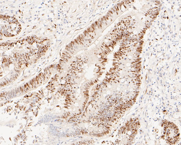 Immunohistochemical analysis of paraffin-embedded human liver carcinoma tissue using anti-Cyclin D1 antibody. The section was pre-treated using heat mediated antigen retrieval with Tris-EDTA buffer (pH 8.0-8.4) for 20 minutes.The tissues were blocked in 5% BSA for 30 minutes at room temperature, washed with ddH2O and PBS, and then probed with the primary antibody (ET1601-31, 1/50) for 30 minutes at room temperature. The detection was performed using an HRP conjugated compact polymer system. DAB was used as the chromogen. Tissues were counterstained with hematoxylin and mounted with DPX.
