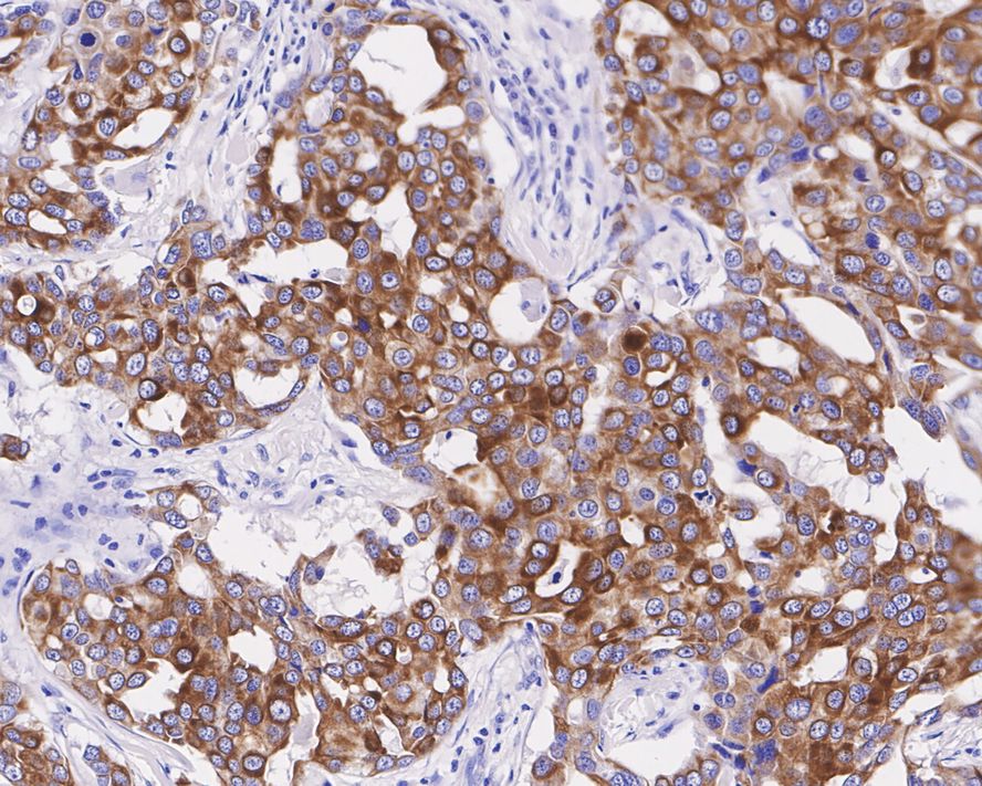 Immunohistochemical analysis of paraffin-embedded human stomach carcinoma tissue using anti-Cytokeratin 19 antibody. The section was pre-treated using heat mediated antigen retrieval with Tris-EDTA buffer (pH 8.0-8.4) for 20 minutes.The tissues were blocked in 5% BSA for 30 minutes at room temperature, washed with ddH2O and PBS, and then probed with the primary antibody (ET1601-6, 1/50) for 30 minutes at room temperature. The detection was performed using an HRP conjugated compact polymer system. DAB was used as the chromogen. Tissues were counterstained with hematoxylin and mounted with DPX.