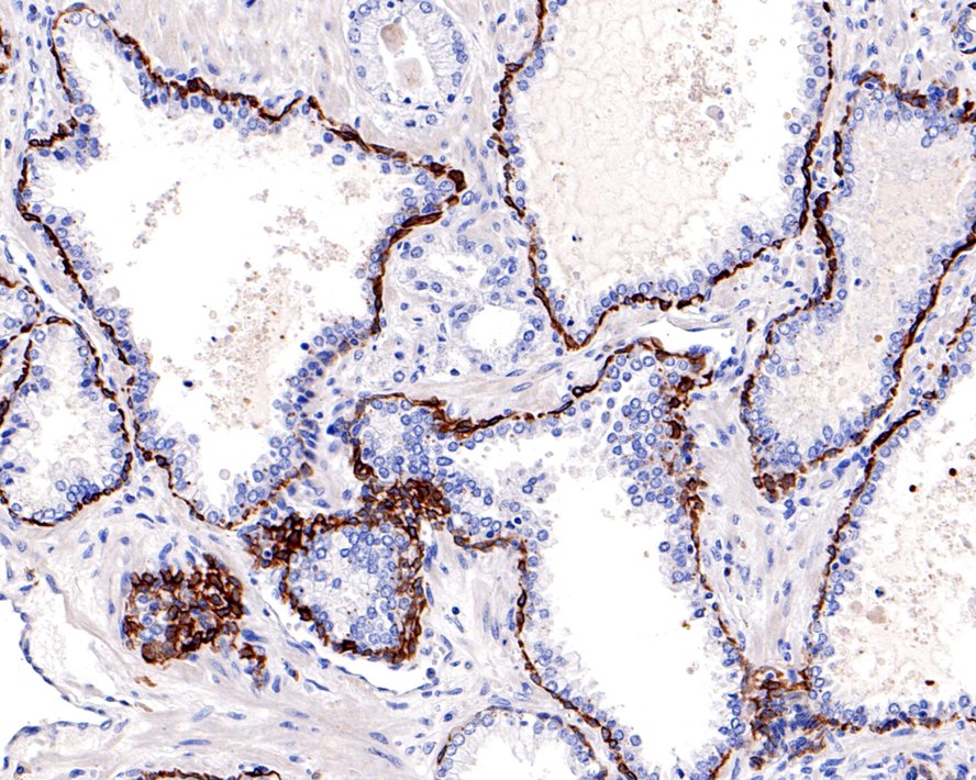 Immunohistochemical analysis of paraffin-embedded human tonsil tissue using anti-Cytokeratin 17 antibody. The section was pre-treated using heat mediated antigen retrieval with Tris-EDTA buffer (pH 8.0-8.4) for 20 minutes.The tissues were blocked in 5% BSA for 30 minutes at room temperature, washed with ddH2O and PBS, and then probed with the primary antibody (ET1602-16, 1/50) for 30 minutes at room temperature. The detection was performed using an HRP conjugated compact polymer system. DAB was used as the chromogen. Tissues were counterstained with hematoxylin and mounted with DPX.
