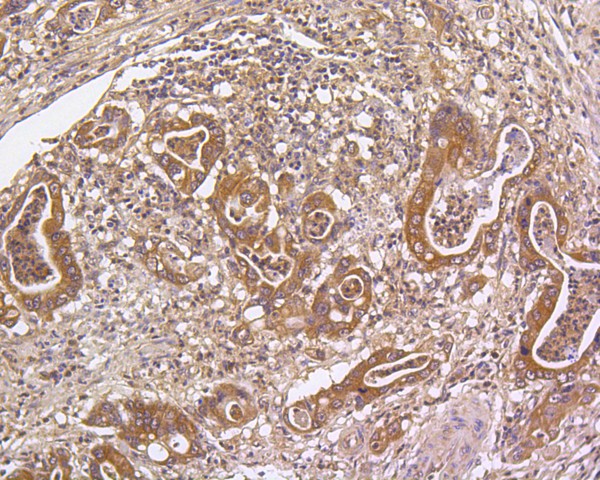 Immunohistochemical analysis of paraffin-embedded human gastric carcinoma tissue using anti-DUSP6 antibody. The section was pre-treated using heat mediated antigen retrieval with Tris-EDTA buffer (pH 8.0-8.4) for 20 minutes.The tissues were blocked in 5% BSA for 30 minutes at room temperature, washed with ddH2O and PBS, and then probed with the primary antibody (ET1602-18, 1/50) for 30 minutes at room temperature. The detection was performed using an HRP conjugated compact polymer system. DAB was used as the chromogen. Tissues were counterstained with hematoxylin and mounted with DPX.