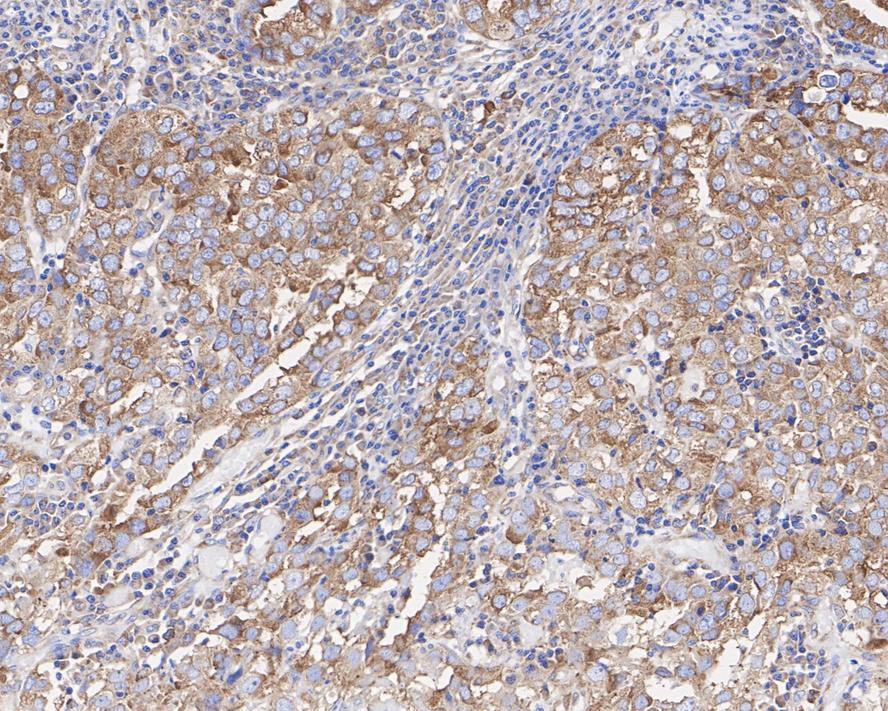 Immunohistochemical analysis of paraffin-embedded human gastric carcinoma tissue using anti-PUMA antibody. The section was pre-treated using heat mediated antigen retrieval with Tris-EDTA buffer (pH 8.0-8.4) for 20 minutes.The tissues were blocked in 5% BSA for 30 minutes at room temperature, washed with ddH2O and PBS, and then probed with the primary antibody (ET1602-24, 1/200) for 30 minutes at room temperature. The detection was performed using an HRP conjugated compact polymer system. DAB was used as the chromogen. Tissues were counterstained with hematoxylin and mounted with DPX.