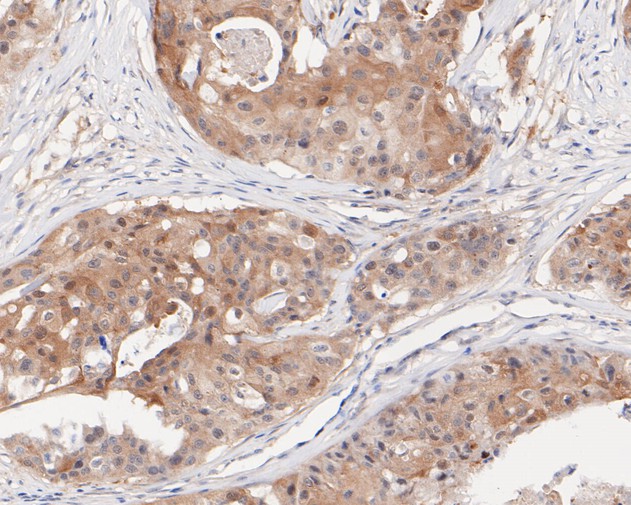 Immunohistochemical analysis of paraffin-embedded human breast carcinoma tissue using anti-IRF1 antibody. The section was pre-treated using heat mediated antigen retrieval with sodium citrate buffer (pH 6.0) for 20 minutes. The tissues were blocked in 5% BSA for 30 minutes at room temperature, washed with ddH2O and PBS, and then probed with the primary antibody (ET1602-28, 1/50)  for 30 minutes at room temperature. The detection was performed using an HRP conjugated compact polymer system. DAB was used as the chromogen. Tissues were counterstained with hematoxylin and mounted with DPX.