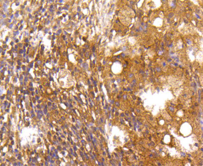Immunohistochemical analysis of paraffin-embedded human lung carcinoma tissue using anti-Caspase-2 antibody. The section was pre-treated using heat mediated antigen retrieval with Tris-EDTA buffer (pH 8.0-8.4) for 20 minutes.The tissues were blocked in 5% BSA for 30 minutes at room temperature, washed with ddH2O and PBS, and then probed with the primary antibody (ET1602-30, 1/50) for 30 minutes at room temperature. The detection was performed using an HRP conjugated compact polymer system. DAB was used as the chromogen. Tissues were counterstained with hematoxylin and mounted with DPX.
