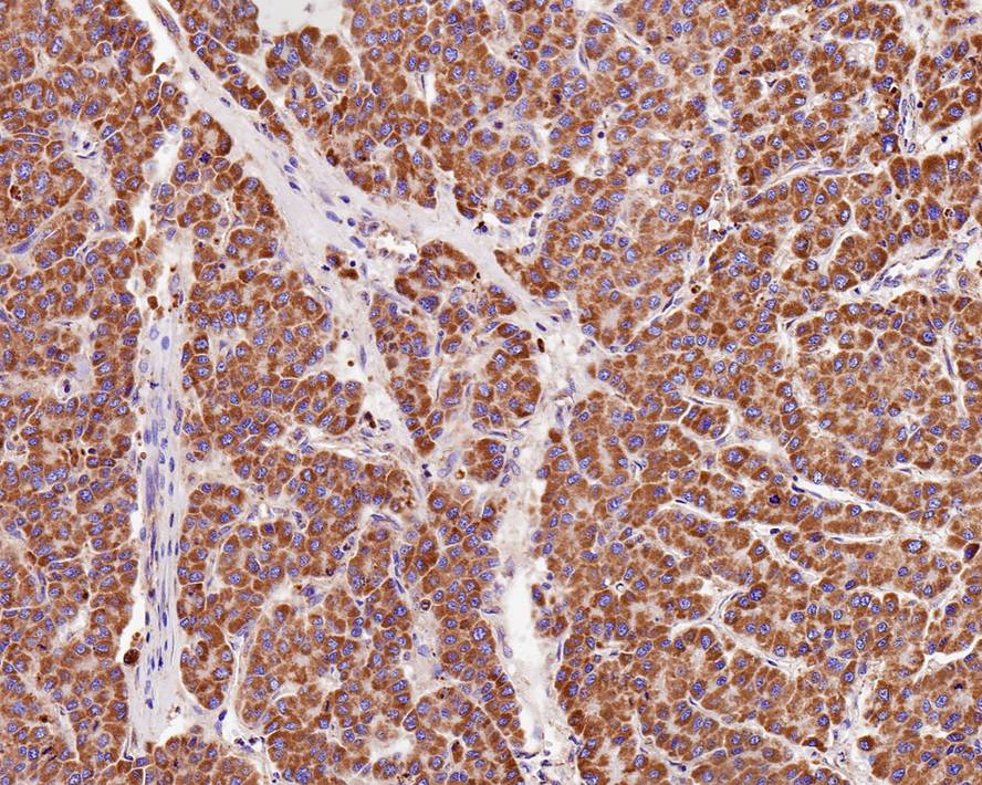 Immunohistochemical analysis of paraffin-embedded human liver carcinoma tissue using anti-Prohibitin antibody. The section was pre-treated using heat mediated antigen retrieval with Tris-EDTA buffer (pH 8.0-8.4) for 20 minutes.The tissues were blocked in 5% BSA for 30 minutes at room temperature, washed with ddH2O and PBS, and then probed with the primary antibody (ET1602-31, 1/200) for 30 minutes at room temperature. The detection was performed using an HRP conjugated compact polymer system. DAB was used as the chromogen. Tissues were counterstained with hematoxylin and mounted with DPX.