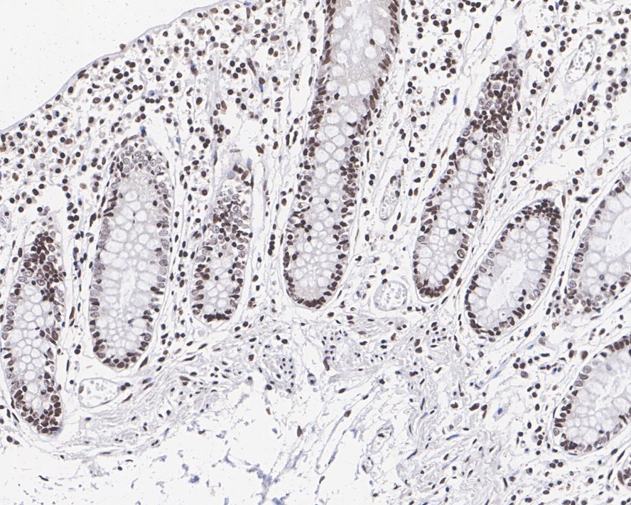 Immunohistochemical analysis of paraffin-embedded human colon tissue using anti-Histone H2A(acetyl K9) antibody. The section was pre-treated using heat mediated antigen retrieval with Tris-EDTA buffer (pH 9.0) for 20 minutes.The tissues were blocked in 1% BSA for 30 minutes at room temperature, washed with ddH2O and PBS, and then probed with the primary antibody (ET1602-34, 1/50) for 30 minutes at room temperature. The detection was performed using an HRP conjugated compact polymer system. DAB was used as the chromogen. Tissues were counterstained with hematoxylin and mounted with DPX.