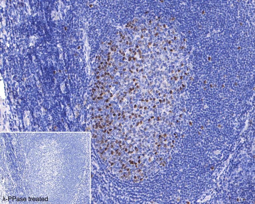 Immunohistochemical analysis of paraffin-embedded human tonsil tissue using anti-Phospho-Rb(S807) antibody. The section was pre-treated using heat mediated antigen retrieval with sodium citrate buffer (pH 6.0) for 20 minutes. The tissues were blocked in 5% BSA for 30 minutes at room temperature, washed with ddH2O and PBS, and then probed with the primary antibody (ET1602-36, 1/200)  for 30 minutes at room temperature. The detection was performed using an HRP conjugated compact polymer system. DAB was used as the chromogen. Tissues were counterstained with hematoxylin and mounted with DPX.