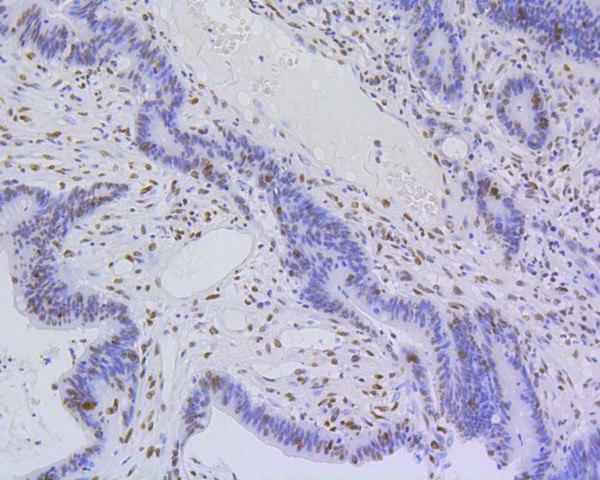 Immunohistochemical analysis of paraffin-embedded human colon carcinoma tissue using anti-Histone H4(acetyl K5) antibody. The section was pre-treated using heat mediated antigen retrieval with Tris-EDTA buffer (pH 9.0) for 20 minutes.The tissues were blocked in 5% BSA for 30 minutes at room temperature, washed with ddH2O and PBS, and then probed with the primary antibody (ET1602-40, 1/200) for 30 minutes at room temperature. The detection was performed using an HRP conjugated compact polymer system. DAB was used as the chromogen. Tissues were counterstained with hematoxylin and mounted with DPX.