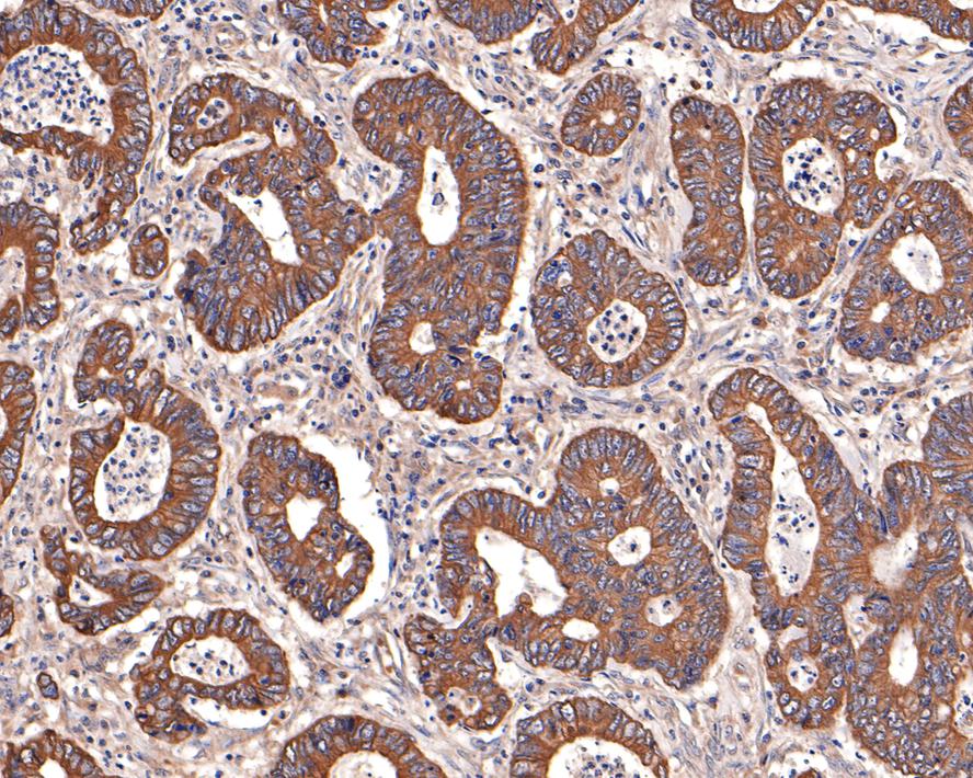 Immunohistochemical analysis of paraffin-embedded human colon carcinoma tissue with Rabbit anti-Active Caspase-3 antibody (ET1602-47) at 1/100 dilution.<br />
<br />
The section was pre-treated using heat mediated antigen retrieval with Tris-EDTA buffer (pH 9.0) for 20 minutes. The tissues were blocked in 1% BSA for 20 minutes at room temperature, washed with ddH2O and PBS, and then probed with the primary antibody (ET1602-47) at 1/100 dilution for 1 hour at room temperature. The detection was performed using an HRP conjugated compact polymer system. DAB was used as the chromogen. Tissues were counterstained with hematoxylin and mounted with DPX.