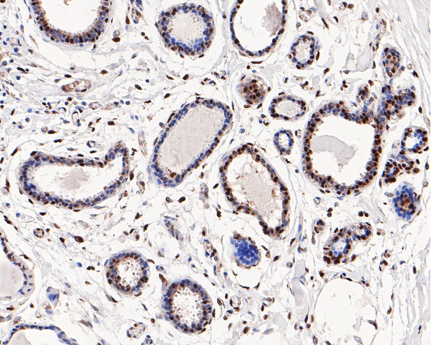Immunohistochemical analysis of paraffin-embedded human breast tissue with Rabbit anti-HP1 alpha antibody (ET1602-8) at 1/200 dilution.<br />
<br />
The section was pre-treated using heat mediated antigen retrieval with sodium citrate buffer (pH 6.0) for 2 minutes. The tissues were blocked in 1% BSA for 20 minutes at room temperature, washed with ddH2O and PBS, and then probed with the primary antibody (ET1602-8) at 1/200 dilution for 1 hour at room temperature. The detection was performed using an HRP conjugated compact polymer system. DAB was used as the chromogen. Tissues were counterstained with hematoxylin and mounted with DPX.