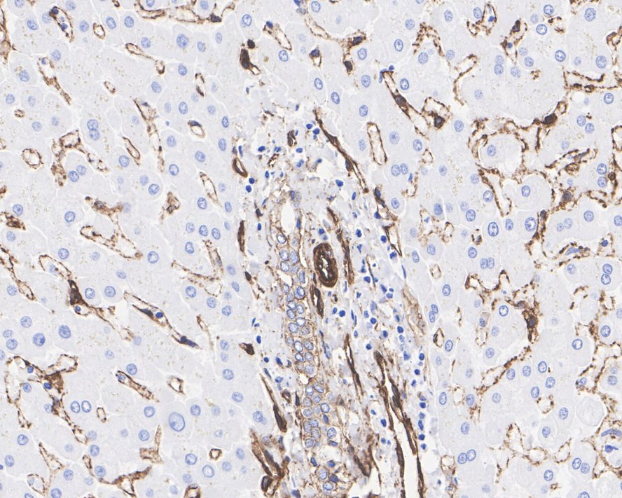 Immunohistochemical analysis of paraffin-embedded human liver carcinoma tissue with Rabbit anti-Caveolin-1 antibody (ET1603-1) at 1/200 dilution.<br />
<br />
The section was pre-treated using heat mediated antigen retrieval with Tris-EDTA buffer (pH 9.0) for 20 minutes. The tissues were blocked in 1% BSA for 20 minutes at room temperature, washed with ddH2O and PBS, and then probed with the primary antibody (ET1603-1) at 1/200 dilution for 1 hour at room temperature. The detection was performed using an HRP conjugated compact polymer system. DAB was used as the chromogen. Tissues were counterstained with hematoxylin and mounted with DPX.
