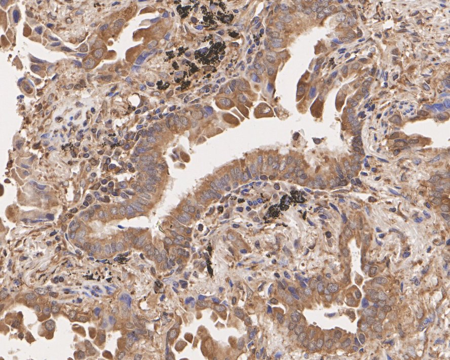 Immunohistochemical analysis of paraffin-embedded human lung squamous cell carcinoma tissue with Rabbit anti-NF-κB p65 antibody (ET1603-12) at 1/400 dilution.<br />
<br />
The section was pre-treated using heat mediated antigen retrieval with Tris-EDTA buffer (pH 9.0) for 20 minutes. The tissues were blocked in 1% BSA for 20 minutes at room temperature, washed with ddH2O and PBS, and then probed with the primary antibody (ET1603-12) at 1/400 dilution for 1 hour at room temperature. The detection was performed using an HRP conjugated compact polymer system. DAB was used as the chromogen. Tissues were counterstained with hematoxylin and mounted with DPX.