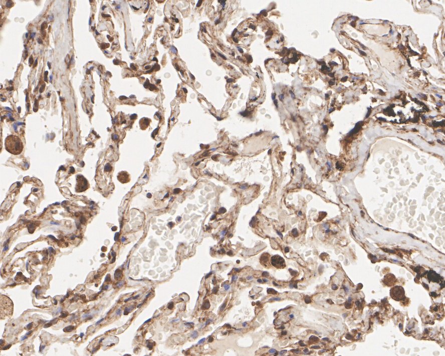 Immunohistochemical analysis of paraffin-embedded human breast carcinoma tissue using anti-NF-κB p65 antibody. The section was pre-treated using heat mediated antigen retrieval with Tris-EDTA buffer (pH 8.0-8.4) for 20 minutes.The tissues were blocked in 5% BSA for 30 minutes at room temperature, washed with ddH2O and PBS, and then probed with the primary antibody (ET1603-12, 1/50) for 30 minutes at room temperature. The detection was performed using an HRP conjugated compact polymer system. DAB was used as the chromogen. Tissues were counterstained with hematoxylin and mounted with DPX.