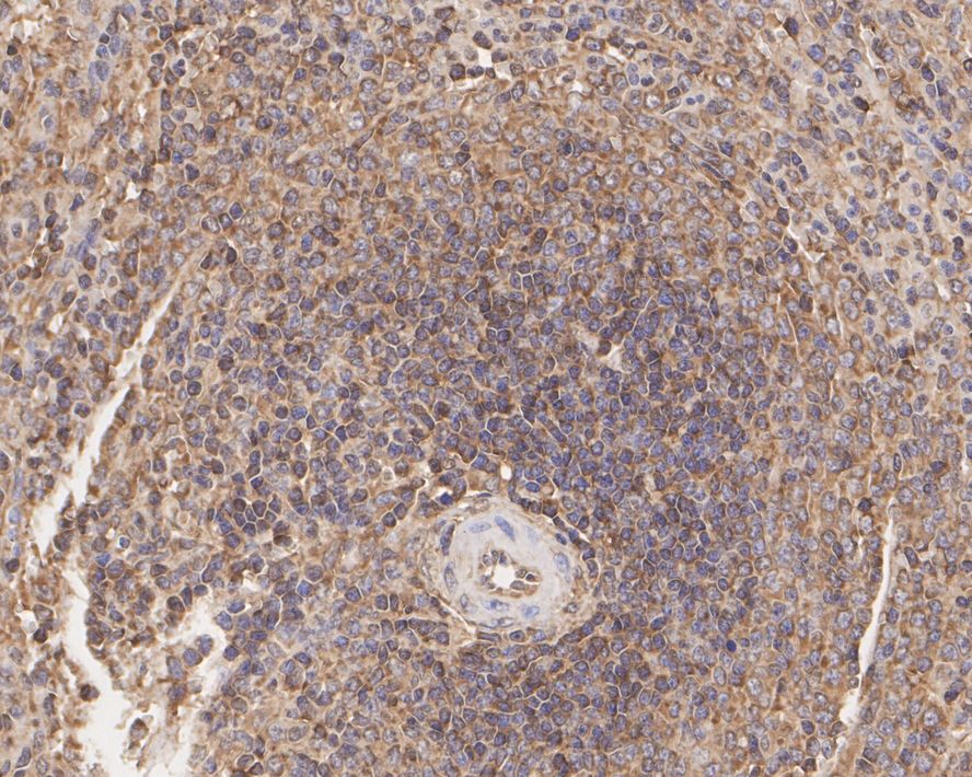 Immunohistochemical analysis of paraffin-embedded human lung tissue with Rabbit anti-NF-κB p65 antibody (ET1603-12) at 1/400 dilution.<br />
<br />
The section was pre-treated using heat mediated antigen retrieval with Tris-EDTA buffer (pH 9.0) for 20 minutes. The tissues were blocked in 1% BSA for 20 minutes at room temperature, washed with ddH2O and PBS, and then probed with the primary antibody (ET1603-12) at 1/400 dilution for 1 hour at room temperature. The detection was performed using an HRP conjugated compact polymer system. DAB was used as the chromogen. Tissues were counterstained with hematoxylin and mounted with DPX.