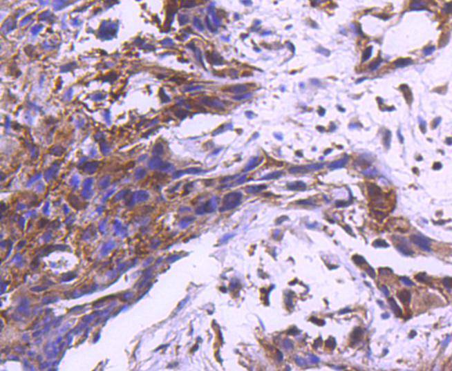 Immunohistochemical analysis of paraffin-embedded human breast carcinoma tissue using anti-MEK1 antibody. The section was pre-treated using heat mediated antigen retrieval with Tris-EDTA buffer (pH 8.0-8.4) for 20 minutes.The tissues were blocked in 5% BSA for 30 minutes at room temperature, washed with ddH2O and PBS, and then probed with the primary antibody (ET1603-20, 1/50) for 30 minutes at room temperature. The detection was performed using an HRP conjugated compact polymer system. DAB was used as the chromogen. Tissues were counterstained with hematoxylin and mounted with DPX.