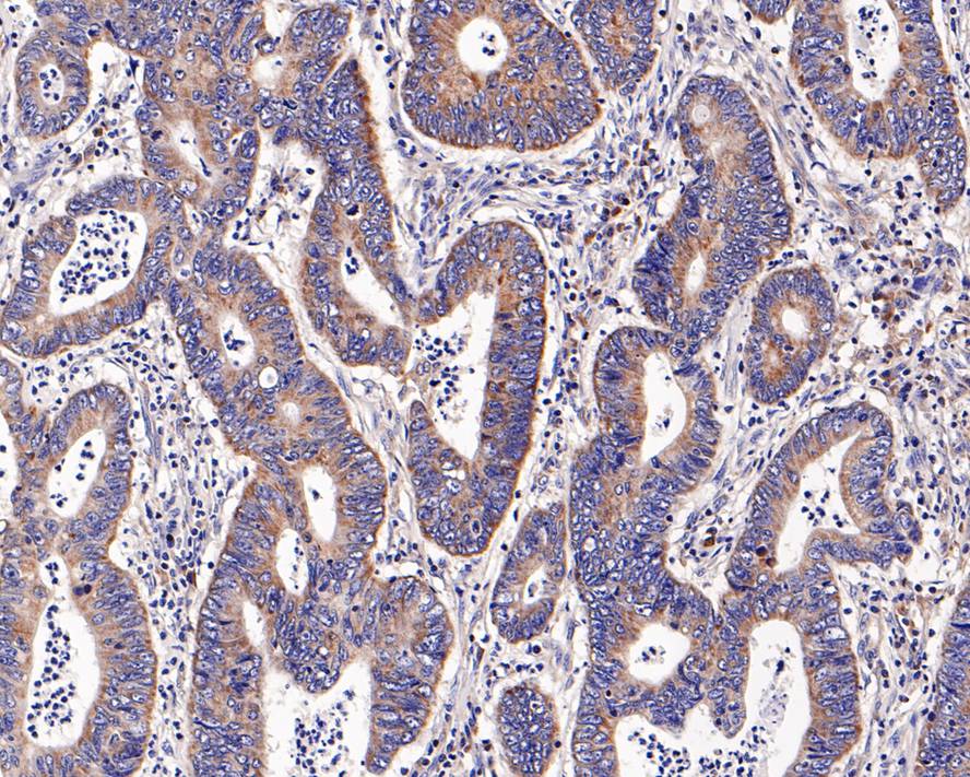 Immunohistochemical analysis of paraffin-embedded human colon carcinoma tissue with Rabbit anti-Bcl-XL antibody (ET1603-28) at 1/1,000 dilution.<br />
<br />
The section was pre-treated using heat mediated antigen retrieval with Tris-EDTA buffer (pH 9.0) for 20 minutes. The tissues were blocked in 1% BSA for 20 minutes at room temperature, washed with ddH2O and PBS, and then probed with the primary antibody (ET1603-28) at 1/1,000 dilution for 1 hour at room temperature. The detection was performed using an HRP conjugated compact polymer system. DAB was used as the chromogen. Tissues were counterstained with hematoxylin and mounted with DPX.