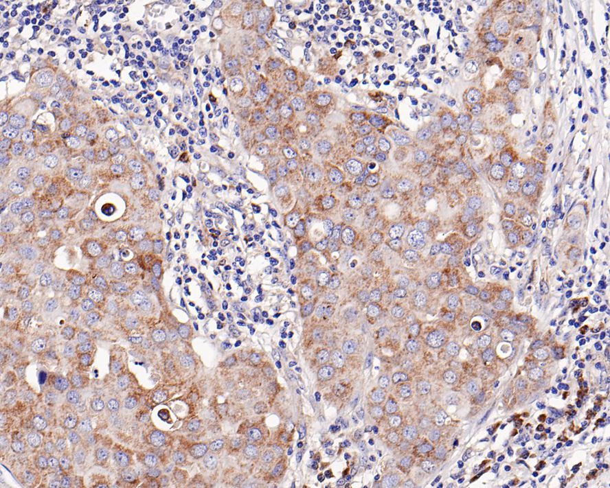 Immunohistochemical analysis of paraffin-embedded human breast carcinoma tissue with Rabbit anti-Bcl-XL antibody (ET1603-28) at 1/200 dilution.<br />
<br />
The section was pre-treated using heat mediated antigen retrieval with Tris-EDTA buffer (pH 9.0) for 20 minutes. The tissues were blocked in 1% BSA for 20 minutes at room temperature, washed with ddH2O and PBS, and then probed with the primary antibody (ET1603-28) at 1/200 dilution for 1 hour at room temperature. The detection was performed using an HRP conjugated compact polymer system. DAB was used as the chromogen. Tissues were counterstained with hematoxylin and mounted with DPX.