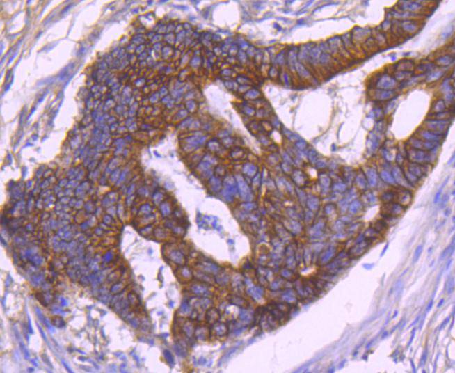 Immunohistochemical analysis of paraffin-embedded human colon tissue with Rabbit anti-Cytokeratin 18 antibody (ET1603-8) at 1/200 dilution. <br />
<br />
The section was pre-treated using heat mediated antigen retrieval with Tris-EDTA buffer (pH 9.0) for 20 minutes.The tissues were blocked in 5% BSA for 30 minutes at room temperature, washed with ddH2O and PBS, and then probed with the primary antibody (ET1603-8, 1/200) for 30 minutes at room temperature. The detection was performed using an HRP conjugated compact polymer system. DAB was used as the chromogen. Tissues were counterstained with hematoxylin and mounted with DPX.