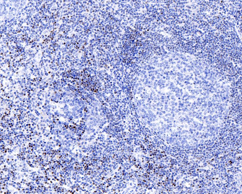 Immunohistochemical analysis of paraffin-embedded human tonsil tissue using anti-SATB1 antibody. <br />
<br />
The section was pre-treated using heat mediated antigen retrieval with sodium citrate buffer (pH 6.0) for 20 minutes. The tissues were blocked in 5% BSA for 30 minutes at room temperature, washed with ddH2O and PBS, and then probed with the primary antibody (ET1604-10, 1/200)  for 30 minutes at room temperature. The detection was performed using an HRP conjugated compact polymer system. DAB was used as the chromogen. Tissues were counterstained with hematoxylin and mounted with DPX.