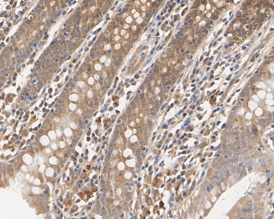 Immunohistochemical analysis of paraffin-embedded human breast carcinoma tissue using anti-Smad4 antibody. <br />
<br />
The section was pre-treated using heat mediated antigen retrieval with Tris-EDTA buffer (pH 8.0-8.4) for 20 minutes.The tissues were blocked in 5% BSA for 30 minutes at room temperature, washed with ddH2O and PBS, and then probed with the primary antibody (ET1604-12, 1/50) for 30 minutes at room temperature. The detection was performed using an HRP conjugated compact polymer system. DAB was used as the chromogen. Tissues were counterstained with hematoxylin and mounted with DPX.