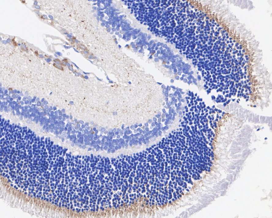 Immunohistochemical analysis of paraffin-embedded human colon carcinoma tissue with Rabbit anti-VEGF antibody (ET1604-28) at 1/50 dilution.<br />
<br />
The section was pre-treated using heat mediated antigen retrieval with Tris-EDTA buffer (pH 9.0) for 20 minutes. The tissues were blocked in 1% BSA for 20 minutes at room temperature, washed with ddH2O and PBS, and then probed with the primary antibody (ET1604-28) at 1/50 dilution for 1 hour at room temperature. The detection was performed using an HRP conjugated compact polymer system. DAB was used as the chromogen. Tissues were counterstained with hematoxylin and mounted with DPX.