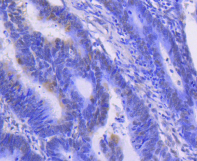 Immunohistochemical analysis of paraffin-embedded human colon carcinoma tissue using anti-ERK1 antibody. The section was pre-treated using heat mediated antigen retrieval with Tris-EDTA buffer (pH 9.0) for 20 minutes.The tissues were blocked in 1% BSA for 30 minutes at room temperature, washed with ddH2O and PBS, and then probed with the primary antibody (ET1604-32, 1/50) for 30 minutes at room temperature. The detection was performed using an HRP conjugated compact polymer system. DAB was used as the chromogen. Tissues were counterstained with hematoxylin and mounted with DPX.
