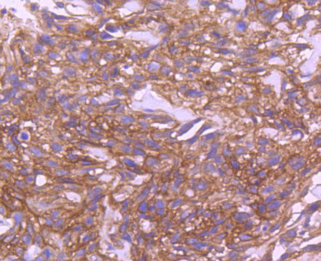Immunohistochemical analysis of paraffin-embedded human breast carcinoma tissue using anti-EGFR antibody. The section was pre-treated using heat mediated antigen retrieval with Tris-EDTA buffer (pH 8.0-8.4) for 20 minutes.The tissues were blocked in 5% BSA for 30 minutes at room temperature, washed with ddH2O and PBS, and then probed with the primary antibody (ET1604-44, 1/50) for 30 minutes at room temperature. The detection was performed using an HRP conjugated compact polymer system. DAB was used as the chromogen. Tissues were counterstained with hematoxylin and mounted with DPX.