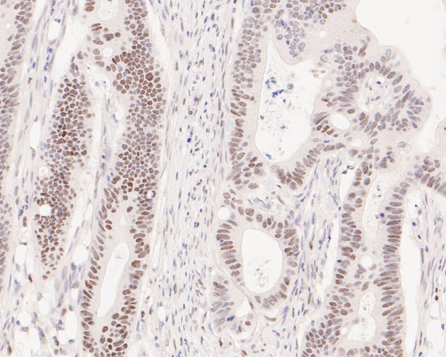 Immunohistochemical analysis of paraffin-embedded human breast carcinoma tissue using anti-PMS2 antibody. The section was pre-treated using heat mediated antigen retrieval with sodium citrate buffer (pH 6.0) for 20 minutes. The tissues were blocked in 5% BSA for 30 minutes at room temperature, washed with ddH2O and PBS, and then probed with the primary antibody (ET1605-1, 1/200)  for 30 minutes at room temperature. The detection was performed using an HRP conjugated compact polymer system. DAB was used as the chromogen. Tissues were counterstained with hematoxylin and mounted with DPX.