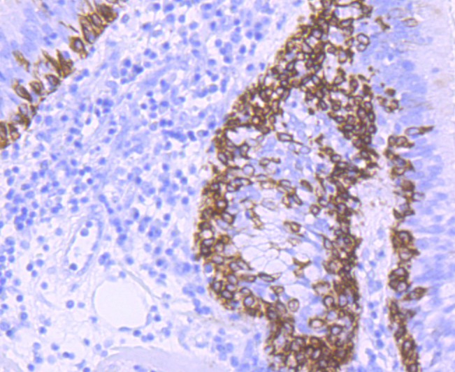 Immunohistochemical analysis of paraffin-embedded human lung cancer tissue using anti-Cytokeratin 5 antibody. Counter stained with hematoxylin.