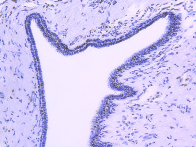 Immunohistochemical analysis of paraffin-embedded human breast carcinoma tissue using anti-FUBP1 antibody. The section was pre-treated using heat mediated antigen retrieval with Tris-EDTA buffer (pH 9.0) for 20 minutes.The tissues were blocked in 1% BSA for 30 minutes at room temperature, washed with ddH2O and PBS, and then probed with the primary antibody (ET1605-26, 1/50) for 30 minutes at room temperature. The detection was performed using an HRP conjugated compact polymer system. DAB was used as the chromogen. Tissues were counterstained with hematoxylin and mounted with DPX.