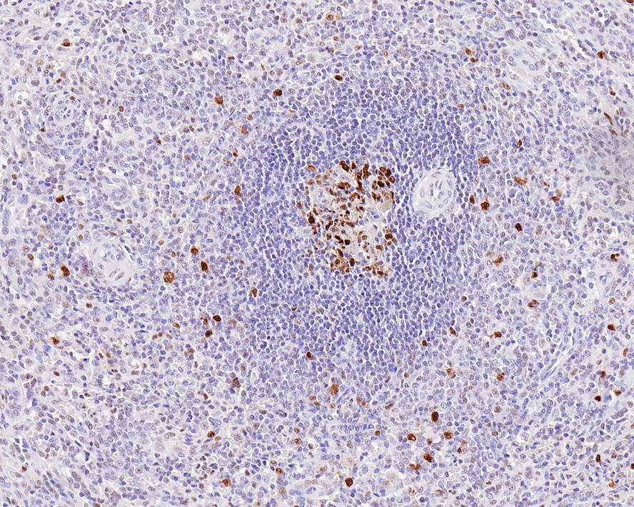 Immunohistochemical analysis of paraffin-embedded human spleen tissue with Rabbit anti-PCNA antibody (ET1605-38) at 1/2,000 dilution.<br />
<br />
The section was pre-treated using heat mediated antigen retrieval with sodium citrate buffer (pH 6.0) for 2 minutes. The tissues were blocked in 1% BSA for 20 minutes at room temperature, washed with ddH2O and PBS, and then probed with the primary antibody (ET1605-38) at 1/2,000 dilution for 1 hour at room temperature. The detection was performed using an HRP conjugated compact polymer system. DAB was used as the chromogen. Tissues were counterstained with hematoxylin and mounted with DPX.