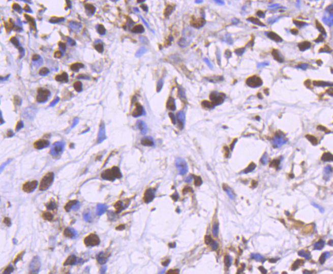 Immunohistochemical analysis of paraffin-embedded human breast carcinoma tissue using anti-PCNA antibody. The section was pre-treated using heat mediated antigen retrieval with Tris-EDTA buffer (pH 8.0-8.4) for 20 minutes.The tissues were blocked in 5% BSA for 30 minutes at room temperature, washed with ddH2O and PBS, and then probed with the primary antibody (ET1605-38, 1/50) for 30 minutes at room temperature. The detection was performed using an HRP conjugated compact polymer system. DAB was used as the chromogen. Tissues were counterstained with hematoxylin and mounted with DPX.