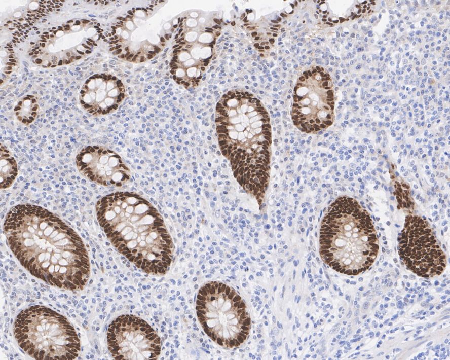 Immunohistochemical analysis of paraffin-embedded human colon tissue with Rabbit anti-CDX2 antibody (ET1605-4) at 1/200 dilution.<br />
<br />
The section was pre-treated using heat mediated antigen retrieval with sodium citrate buffer (pH 6.0) for 2 minutes. The tissues were blocked in 1% BSA for 20 minutes at room temperature, washed with ddH2O and PBS, and then probed with the primary antibody (ET1605-4) at 1/400 dilution for 1 hour at room temperature. The detection was performed using an HRP conjugated compact polymer system. DAB was used as the chromogen. Tissues were counterstained with hematoxylin and mounted with DPX.