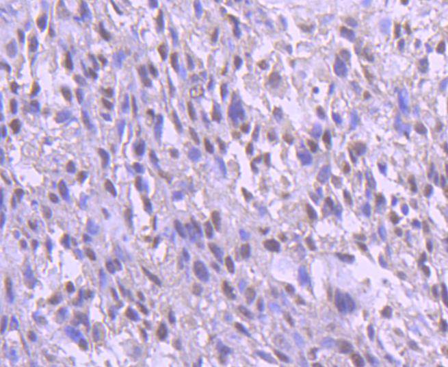 Immunohistochemical analysis of paraffin-embedded human breast carcinoma tissue using anti-YY1 antibody. The section was pre-treated using heat mediated antigen retrieval with Tris-EDTA buffer (pH 8.0-8.4) for 20 minutes.The tissues were blocked in 5% BSA for 30 minutes at room temperature, washed with ddH2O and PBS, and then probed with the primary antibody (ET1605-40, 1/50) for 30 minutes at room temperature. The detection was performed using an HRP conjugated compact polymer system. DAB was used as the chromogen. Tissues were counterstained with hematoxylin and mounted with DPX.