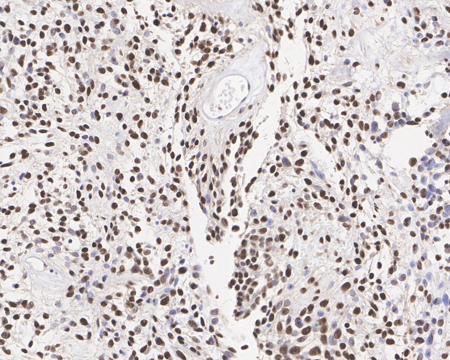 ICC staining of STAT6 in HepG2 cells (green). Formalin fixed cells were permeabilized with 0.1% Triton X-100 in TBS for 10 minutes at room temperature and blocked with 10% negative goat serum for 15 minutes at room temperature. Cells were probed with the primary antibody (ET1605-49, 1/50) for 1 hour at room temperature, washed with PBS. Alexa Fluor®488 conjugate-Goat anti-Rabbit IgG was used as the secondary antibody at 1/1,000 dilution. The nuclear counter stain is DAPI (blue).