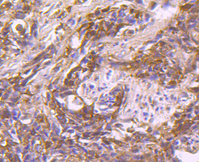 Immunohistochemical analysis of paraffin-embedded human colon carcinoma tissue using anti-Hsp90 beta antibody. The section was pre-treated using heat mediated antigen retrieval with Tris-EDTA buffer (pH 8.0-8.4) for 20 minutes.The tissues were blocked in 5% BSA for 30 minutes at room temperature, washed with ddH2O and PBS, and then probed with the primary antibody (ET1605-56, 1/200) for 30 minutes at room temperature. The detection was performed using an HRP conjugated compact polymer system. DAB was used as the chromogen. Tissues were counterstained with hematoxylin and mounted with DPX.
