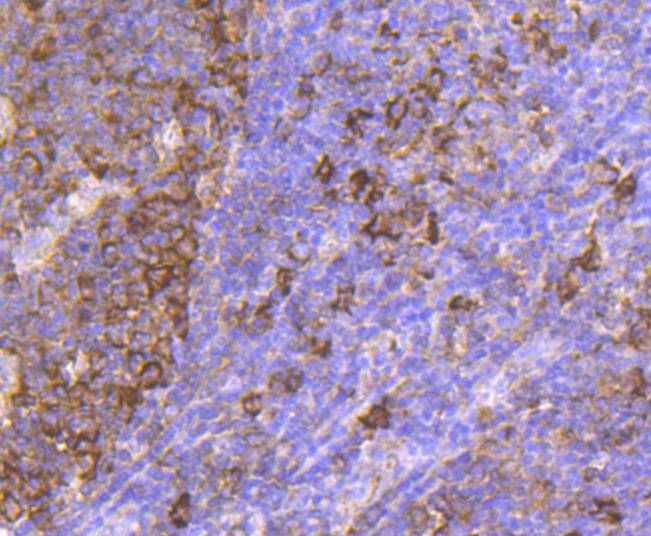 Immunohistochemical analysis of paraffin-embedded human breast carcinoma tissue using anti-Hsp90 beta antibody. The section was pre-treated using heat mediated antigen retrieval with Tris-EDTA buffer (pH 8.0-8.4) for 20 minutes.The tissues were blocked in 5% BSA for 30 minutes at room temperature, washed with ddH2O and PBS, and then probed with the primary antibody (ET1605-56, 1/200) for 30 minutes at room temperature. The detection was performed using an HRP conjugated compact polymer system. DAB was used as the chromogen. Tissues were counterstained with hematoxylin and mounted with DPX.