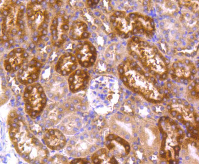 Immunohistochemical analysis of paraffin-embedded human colon carcinoma tissue using anti-Hsp90 alpha antibody. The section was pre-treated using heat mediated antigen retrieval with Tris-EDTA buffer (pH 8.0-8.4) for 20 minutes.The tissues were blocked in 5% BSA for 30 minutes at room temperature, washed with ddH2O and PBS, and then probed with the primary antibody (ET1605-57, 1/50) for 30 minutes at room temperature. The detection was performed using an HRP conjugated compact polymer system. DAB was used as the chromogen. Tissues were counterstained with hematoxylin and mounted with DPX.