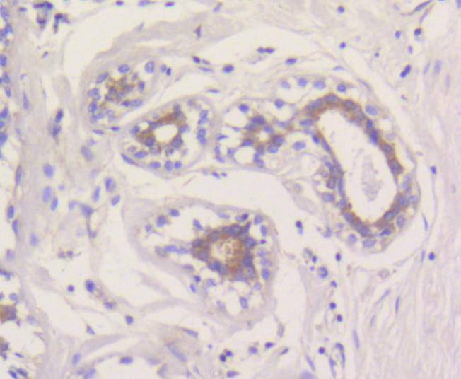 Immunohistochemical analysis of paraffin-embedded human breast tissue using anti-MCL1 antibody. The section was pre-treated using heat mediated antigen retrieval with Tris-EDTA buffer (pH 8.0-8.4) for 20 minutes.The tissues were blocked in 5% BSA for 30 minutes at room temperature, washed with ddH2O and PBS, and then probed with the primary antibody (ET1606-14, 1/50) for 30 minutes at room temperature. The detection was performed using an HRP conjugated compact polymer system. DAB was used as the chromogen. Tissues were counterstained with hematoxylin and mounted with DPX.