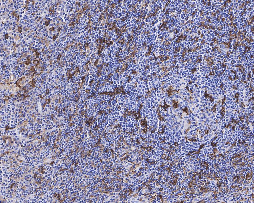 Immunohistochemical analysis of paraffin-embedded human Hodgkin's lymphoma tissue with Rabbit anti-CD11c antibody (ET1606-19) at 1/800 dilution.<br />
<br />
The section was pre-treated using heat mediated antigen retrieval with Tris-EDTA buffer (pH 9.0) for 20 minutes. The tissues were blocked in 1% BSA for 20 minutes at room temperature, washed with ddH2O and PBS, and then probed with the primary antibody (ET1606-19) at 1/800 dilution for 1 hour at room temperature. The detection was performed using an HRP conjugated compact polymer system. DAB was used as the chromogen. Tissues were counterstained with hematoxylin and mounted with DPX.