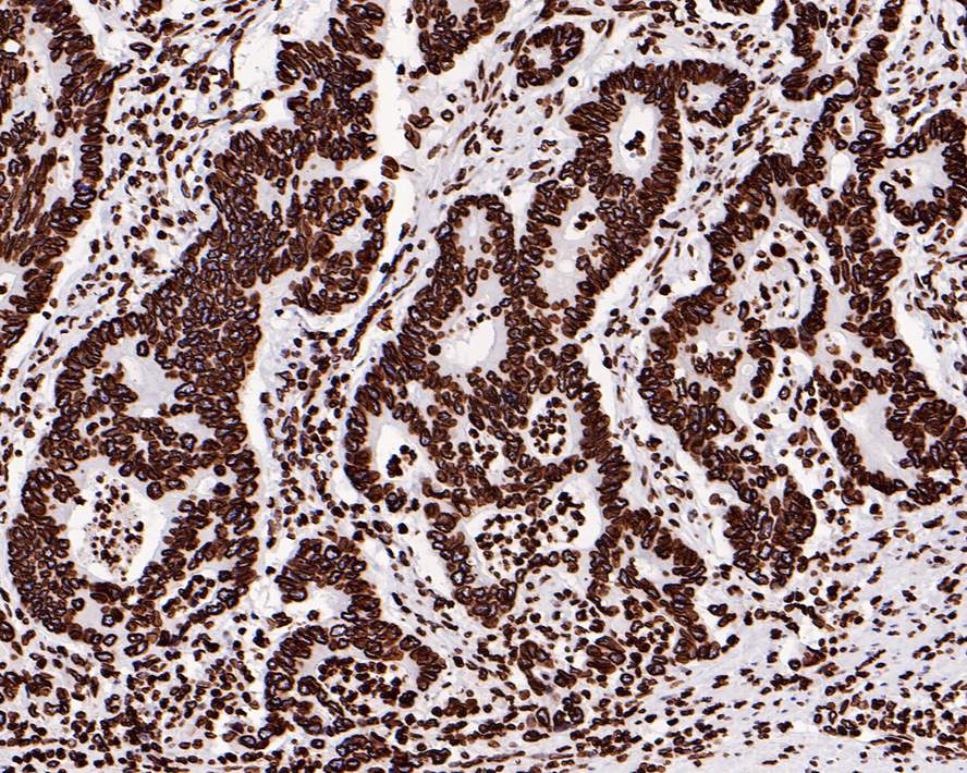 Immunohistochemical analysis of paraffin-embedded human breast carcinoma tissue using anti-Lamin B1 antibody. The section was pre-treated using heat mediated antigen retrieval with Tris-EDTA buffer (pH 8.0-8.4) for 20 minutes.The tissues were blocked in 5% BSA for 30 minutes at room temperature, washed with ddH2O and PBS, and then probed with the primary antibody (ET1606-27, 1/50) for 30 minutes at room temperature. The detection was performed using an HRP conjugated compact polymer system. DAB was used as the chromogen. Tissues were counterstained with hematoxylin and mounted with DPX.