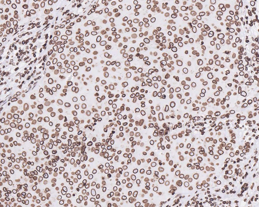 Immunohistochemical analysis of paraffin-embedded human breast carcinoma tissue with Rabbit anti-Lamin B1 antibody (ET1606-27) at 1/1,000 dilution.<br />
<br />
The section was pre-treated using heat mediated antigen retrieval with Tris-EDTA buffer (pH 9.0) for 20 minutes. The tissues were blocked in 1% BSA for 20 minutes at room temperature, washed with ddH2O and PBS, and then probed with the primary antibody (ET1606-27) at 1/1,000 dilution for 1 hour at room temperature. The detection was performed using an HRP conjugated compact polymer system. DAB was used as the chromogen. Tissues were counterstained with hematoxylin and mounted with DPX.