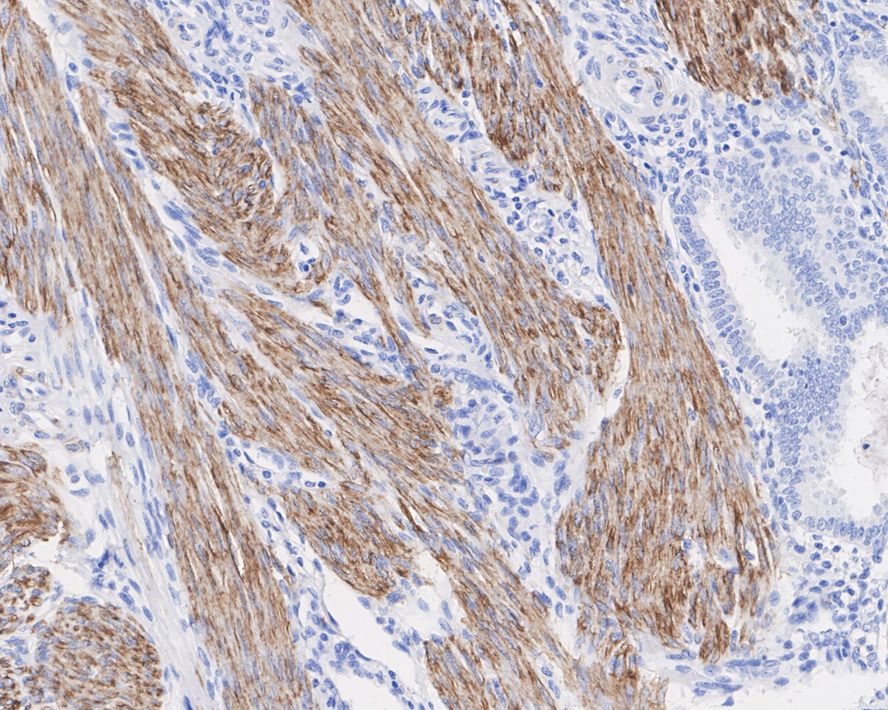 Immunohistochemical analysis of paraffin-embedded human uterus tissue using anti-Desmin antibody. The section was pre-treated using heat mediated antigen retrieval with Tris-EDTA buffer (pH 9.0) for 20 minutes.The tissues were blocked in 1% BSA for 30 minutes at room temperature, washed with ddH2O and PBS, and then probed with the primary antibody (ET1606-30, 1/50) for 30 minutes at room temperature. The detection was performed using an HRP conjugated compact polymer system. DAB was used as the chromogen. Tissues were counterstained with hematoxylin and mounted with DPX.