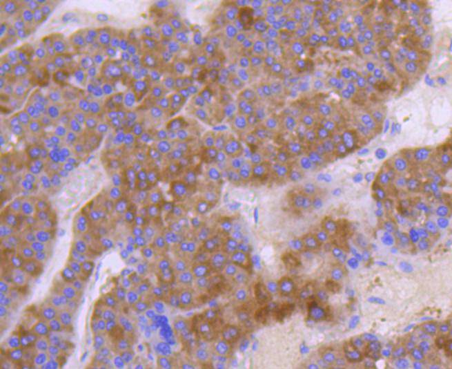 Immunohistochemical analysis of paraffin-embedded human liver carcinoma tissue using anti-Met(C-Met) antibody. The section was pre-treated using heat mediated antigen retrieval with Tris-EDTA buffer (pH 8.0-8.4) for 20 minutes.The tissues were blocked in 5% BSA for 30 minutes at room temperature, washed with ddH2O and PBS, and then probed with the primary antibody (ET1606-45, 1/50) for 30 minutes at room temperature. The detection was performed using an HRP conjugated compact polymer system. DAB was used as the chromogen. Tissues were counterstained with hematoxylin and mounted with DPX.