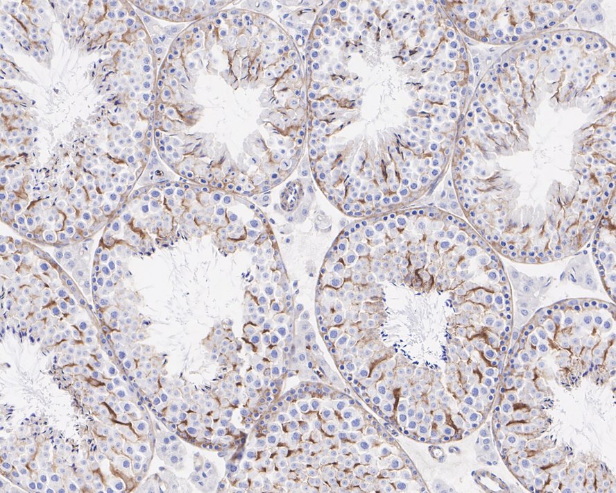 Immunohistochemical analysis of paraffin-embedded human liver carcinoma tissue using anti-Integrin beta 3 antibody. The section was pre-treated using heat mediated antigen retrieval with Tris-EDTA buffer (pH 8.0-8.4) for 20 minutes.The tissues were blocked in 5% BSA for 30 minutes at room temperature, washed with ddH2O and PBS, and then probed with the primary antibody (ET1606-49, 1/50) for 30 minutes at room temperature. The detection was performed using an HRP conjugated compact polymer system. DAB was used as the chromogen. Tissues were counterstained with hematoxylin and mounted with DPX.