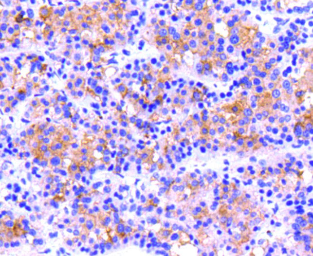 Immunohistochemical analysis of paraffin-embedded human breast carcinoma tissue using anti-Integrin beta 3 antibody. The section was pre-treated using heat mediated antigen retrieval with Tris-EDTA buffer (pH 8.0-8.4) for 20 minutes.The tissues were blocked in 5% BSA for 30 minutes at room temperature, washed with ddH2O and PBS, and then probed with the primary antibody (ET1606-49, 1/50) for 30 minutes at room temperature. The detection was performed using an HRP conjugated compact polymer system. DAB was used as the chromogen. Tissues were counterstained with hematoxylin and mounted with DPX.