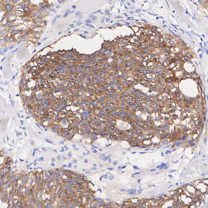 ICC staining Synaptophysin in PC-12 cells (red). The nuclear counter stain is DAPI (blue). Cells were fixed in paraformaldehyde, permeabilised with 0.25% Triton X100/PBS.