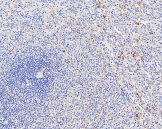 Immunohistochemical analysis of paraffin-embedded human breast tissue using anti-Phospho-PKR(T446) antibody. The section was pre-treated using heat mediated antigen retrieval with sodium citrate buffer (pH 6.0) for 20 minutes. The tissues were blocked in 5% BSA for 30 minutes at room temperature, washed with ddH2O and PBS, and then probed with the primary antibody (ET1607-20, 1/50)  for 30 minutes at room temperature. The detection was performed using an HRP conjugated compact polymer system. DAB was used as the chromogen. Tissues were counterstained with hematoxylin and mounted with DPX.