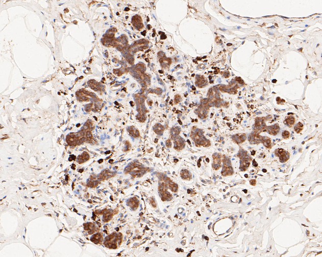 Immunohistochemical analysis of paraffin-embedded human breast carcinoma tissue using anti-Phospho-PKR(T446) antibody. The section was pre-treated using heat mediated antigen retrieval with sodium citrate buffer (pH 6.0) for 20 minutes. The tissues were blocked in 5% BSA for 30 minutes at room temperature, washed with ddH2O and PBS, and then probed with the primary antibody (ET1607-20, 1/50)  for 30 minutes at room temperature. The detection was performed using an HRP conjugated compact polymer system. DAB was used as the chromogen. Tissues were counterstained with hematoxylin and mounted with DPX.