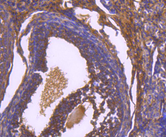 Immunohistochemical analysis of paraffin-embedded human breast carcinoma tissue using anti-Paxillin antibody. The section was pre-treated using heat mediated antigen retrieval with Tris-EDTA buffer (pH 8.0-8.4) for 20 minutes.The tissues were blocked in 5% BSA for 30 minutes at room temperature, washed with ddH2O and PBS, and then probed with the primary antibody (ET1607-22, 1/50) for 30 minutes at room temperature. The detection was performed using an HRP conjugated compact polymer system. DAB was used as the chromogen. Tissues were counterstained with hematoxylin and mounted with DPX.
